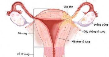Bệnh nhân viêm phụ khoa cần chú ý gì trong ăn uống ? Viêm phụ khoa chú ý gì