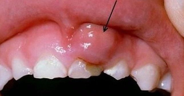 Sưng nướu răng là tình trạng rất nhiều người gặp phải